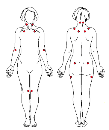 fibromyalgia pain points