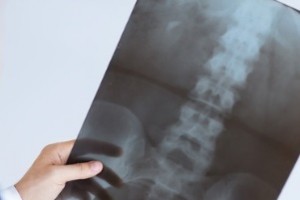 chiropractor examining spinal x-ray