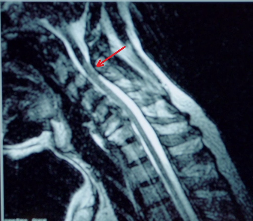 jim mcmahon neck misalignment - for blog with arrow